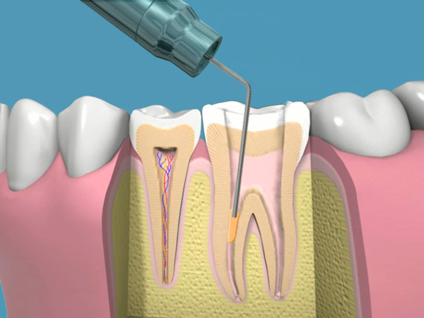 ¿Endodoncia o implantes?