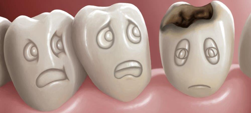 Descubre cuál es tu riesgo de caries dental